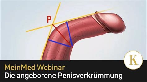 peniskrankheiten|6 Peniskrankheiten: Symptome und Arztbesuch